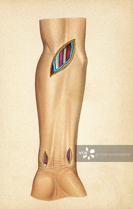 外科手术切割皮肤和内脏的旧彩色石印插图图片素材