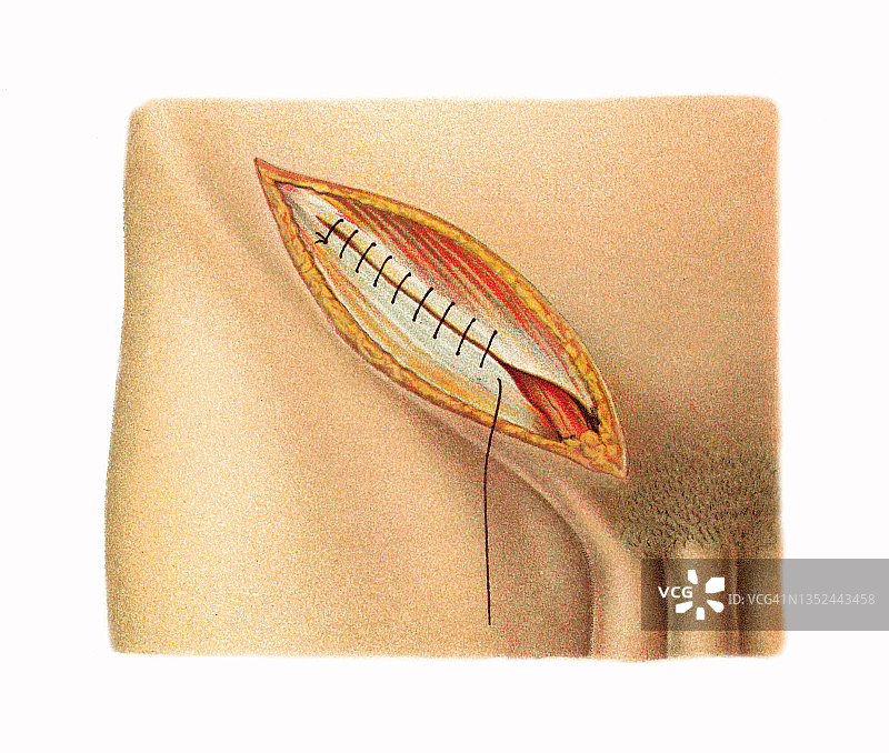 开放性腹股沟疝修补术彩色石印插图图片素材