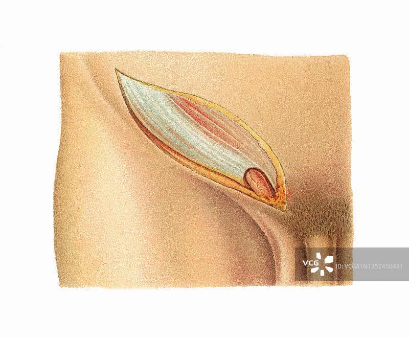 开放性腹股沟疝修补术彩色石印插图图片素材