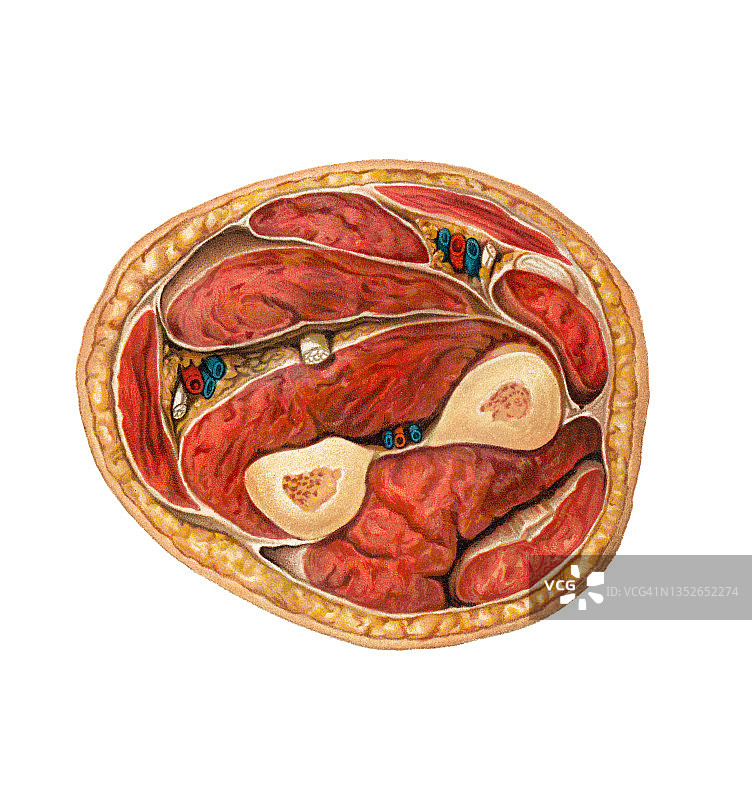 外科手术、前臂横截面古董彩 lithograph 插图图片素材