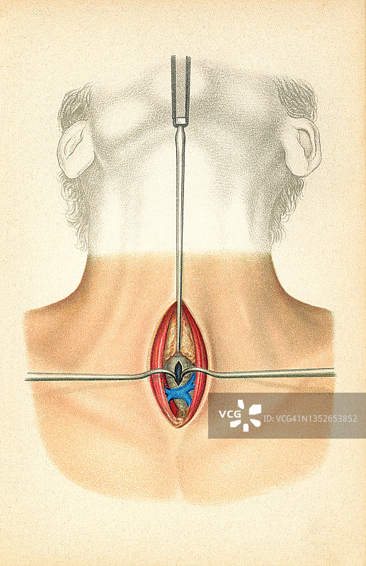咽成形术和气管切开术老式彩色石印插图图片素材