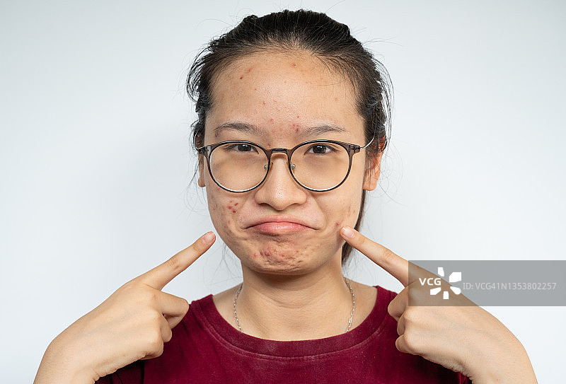年轻亚洲女性指着脸上发炎的痤疮图片素材