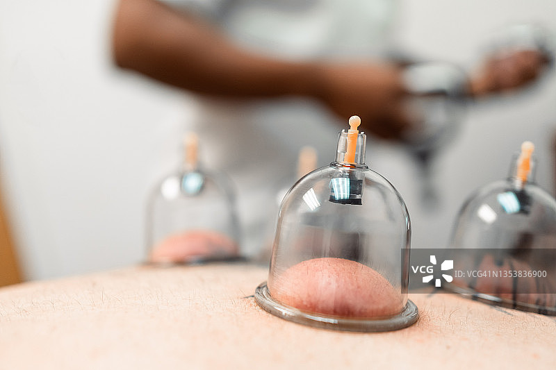 拔罐疗法图片素材