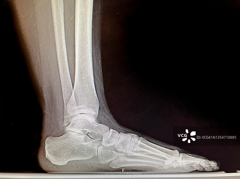 腿部X光片图片素材