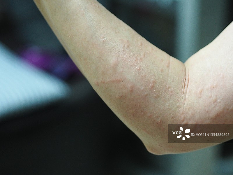 女性手臂因虫咬出现红色水泡皮疹图片素材