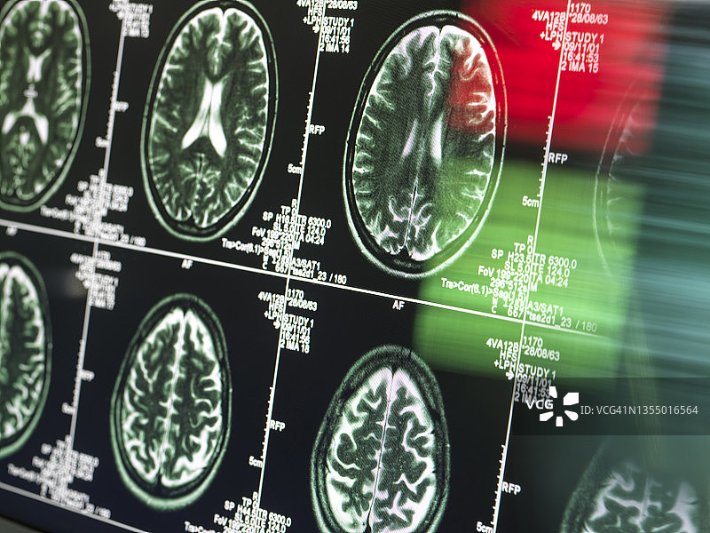 神经内科MRI医学扫描图片素材