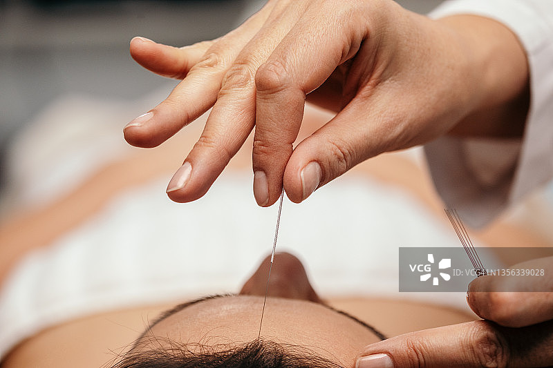 面部针灸治疗图片素材