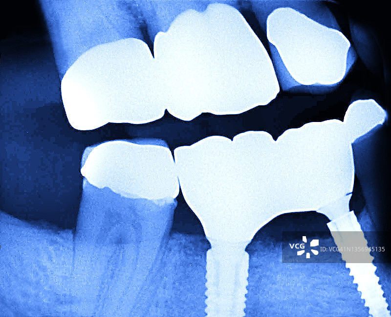 牙齿种植体图片素材