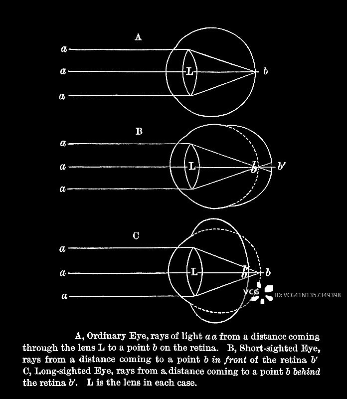 人眼解剖学古老雕刻插图：健康眼、近视和远视图片素材