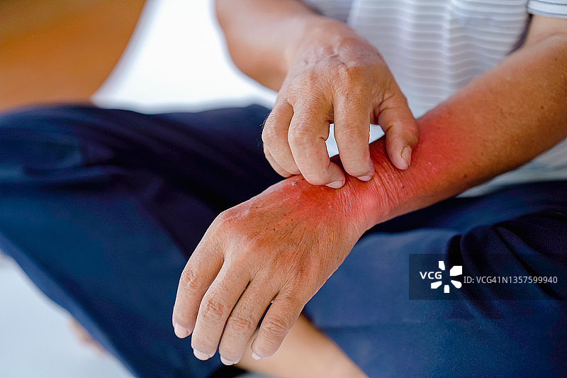 男子手腕划痕或由过敏或昆虫叮咬引起图片素材