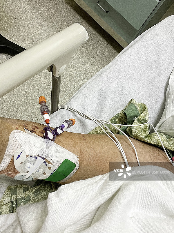 双中心静脉输液图片素材