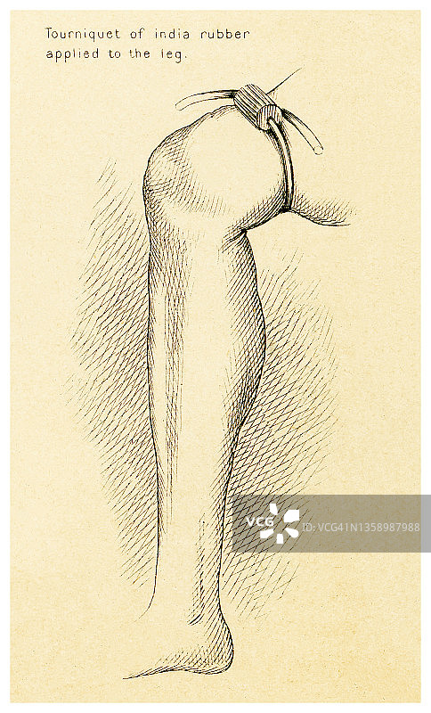 止血方法：应用于腿部的印度橡胶止血带复古雕刻插图图片素材