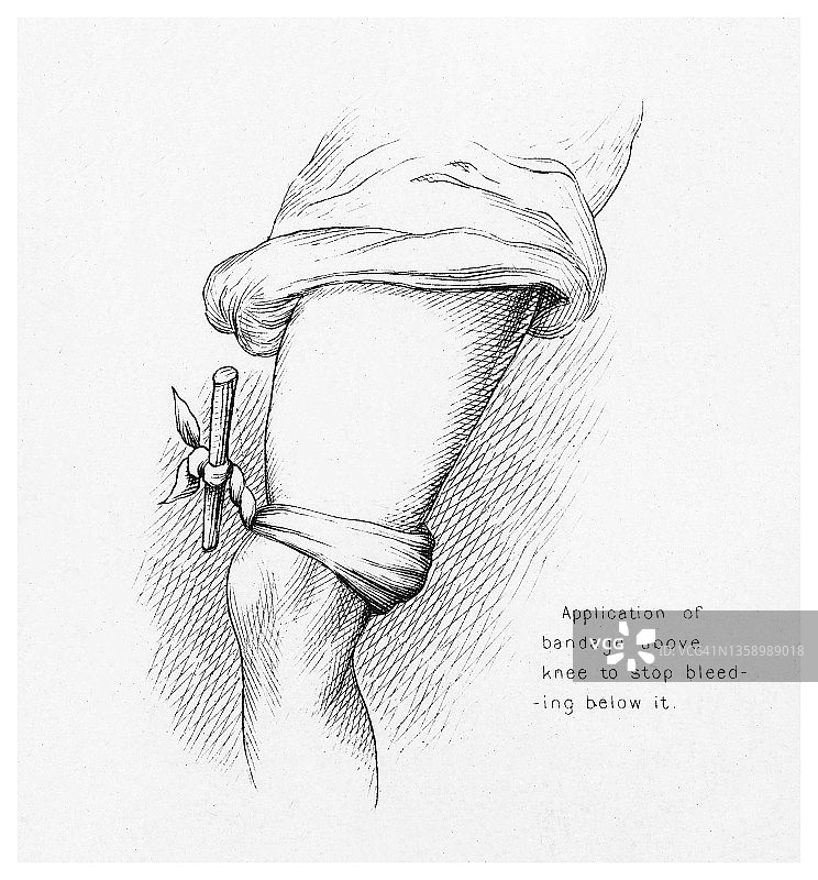 止血方法老式雕刻插图：膝盖上方包扎绷带以阻止下方出血图片素材