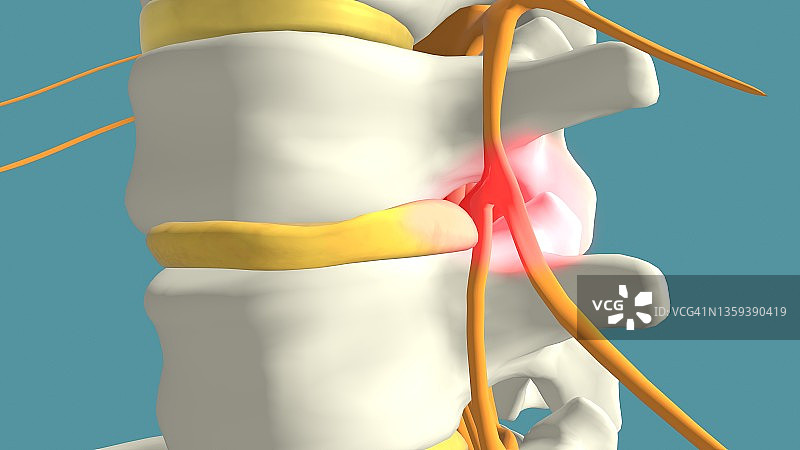 椎间盘突出，图示图片素材