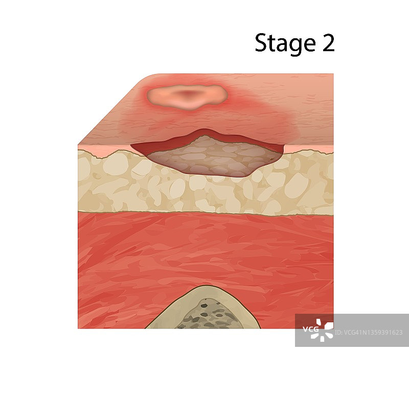 二期压疮插图图片素材