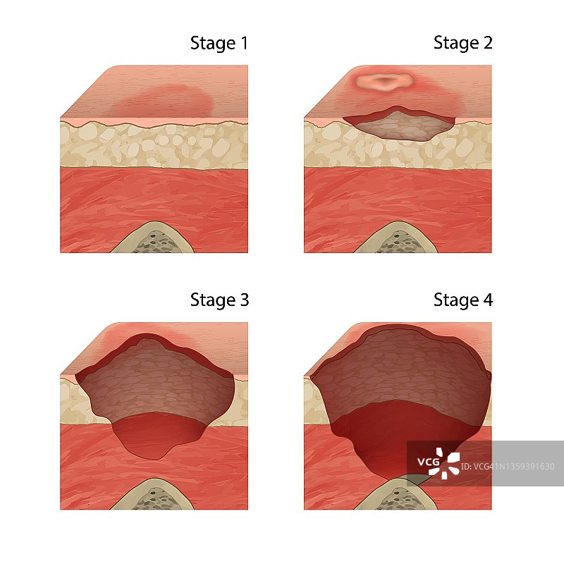 褥疮分期图示图片素材