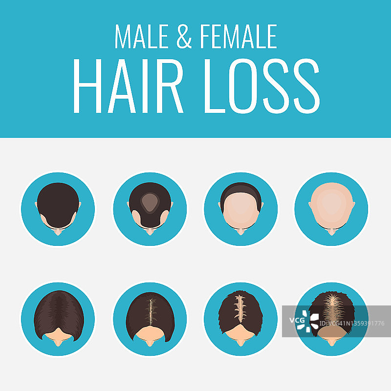 男女型脱发，图示图片素材