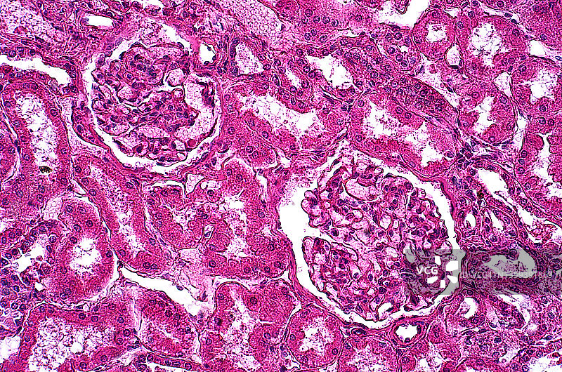 糖原贮积症，光学显微照片图片素材