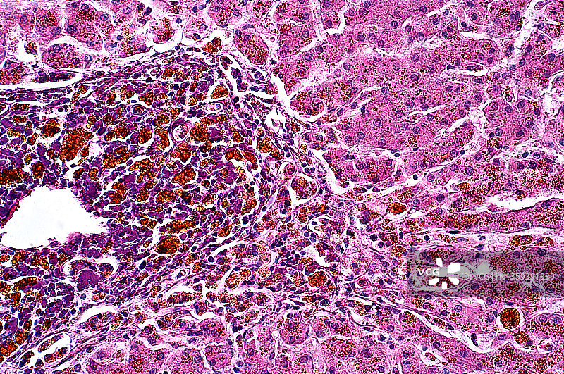 异常肝细胞，光学显微照片图片素材