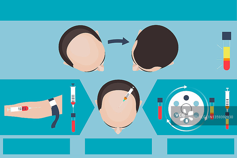 富血小板血浆男性脱发治疗插图图片素材