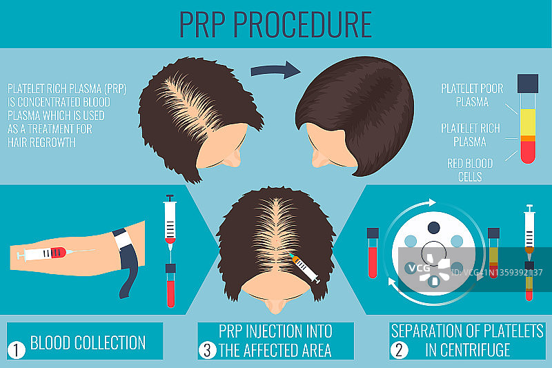 富血小板血浆治疗女性脱发插画图片素材