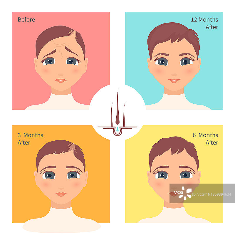 女性植发手术效果图图片素材