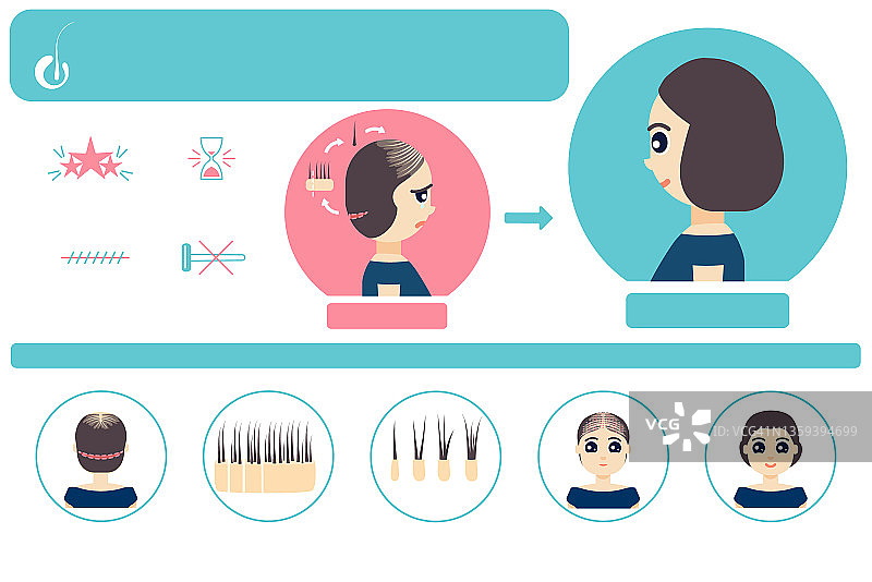 女性FUT毛发移植图示图片素材