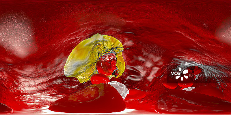 动脉粥样硬化示意图图片素材