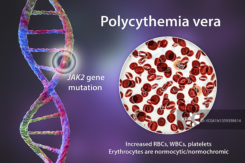 真性红细胞增多症插画图片素材