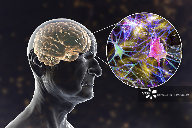 认知障碍与阿尔茨海默病概念图图片素材