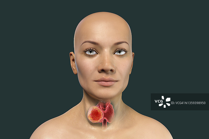 甲状腺肿瘤插图图片素材