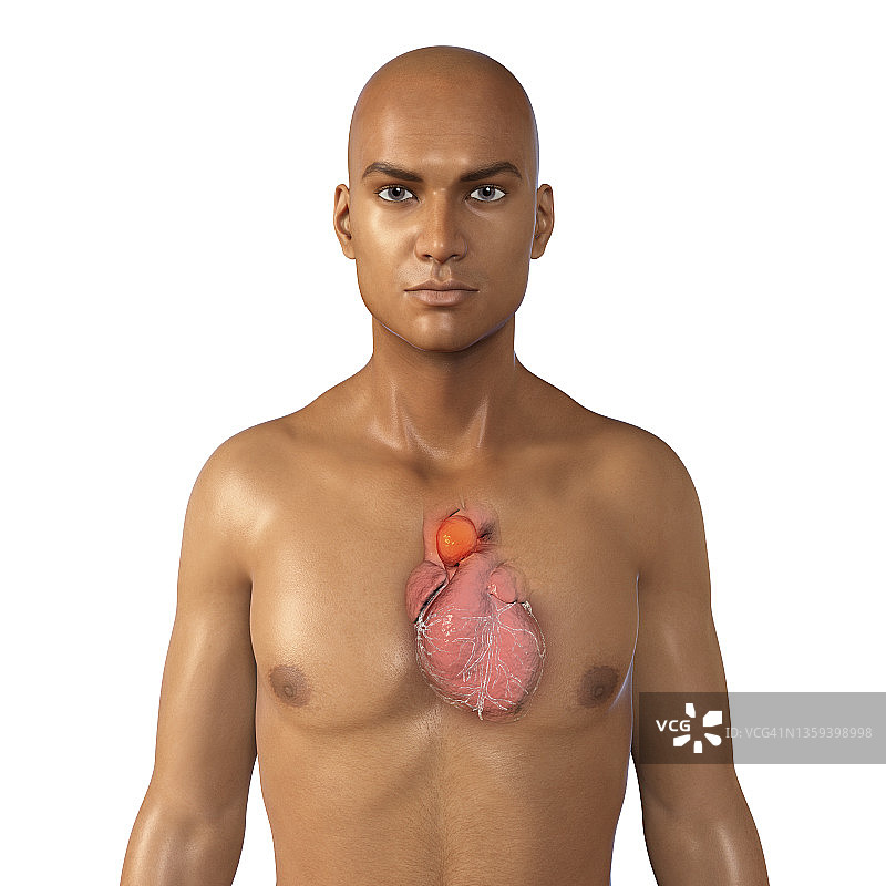 主动脉动脉瘤插图图片素材