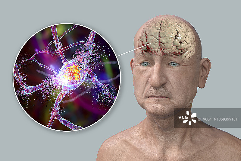 患有痴呆症的老人插画图片素材