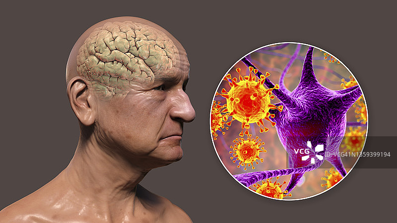 痴呆症的传染性病因，图示图片素材