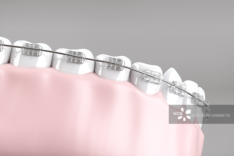 牙科托槽图片素材