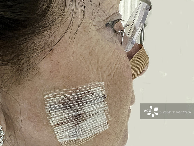 系列-医疗：老年妇女面部莫氏手术图片素材