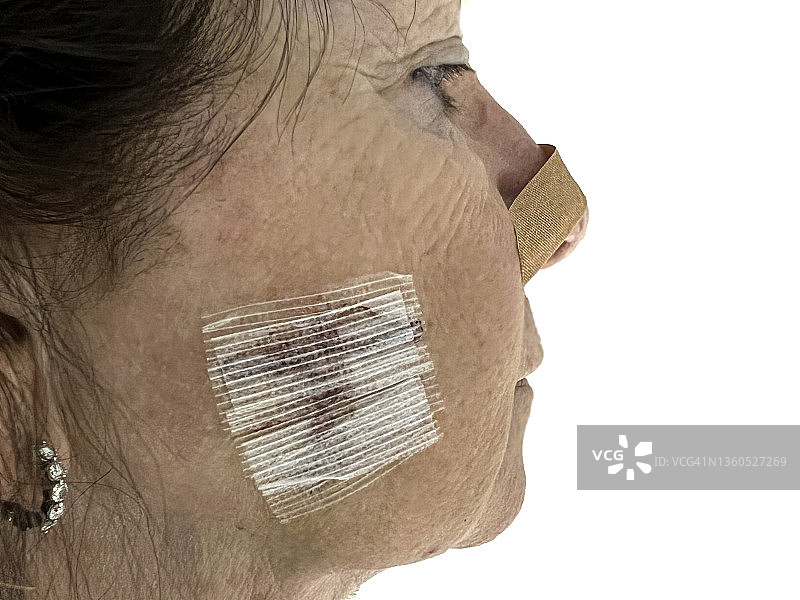 系列-医疗：老年妇女面部莫氏手术图片素材