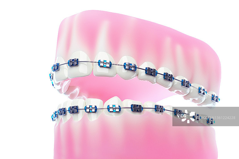 牙科托槽图片素材