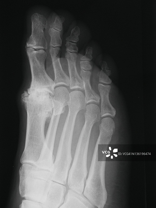 足部X光片图片素材