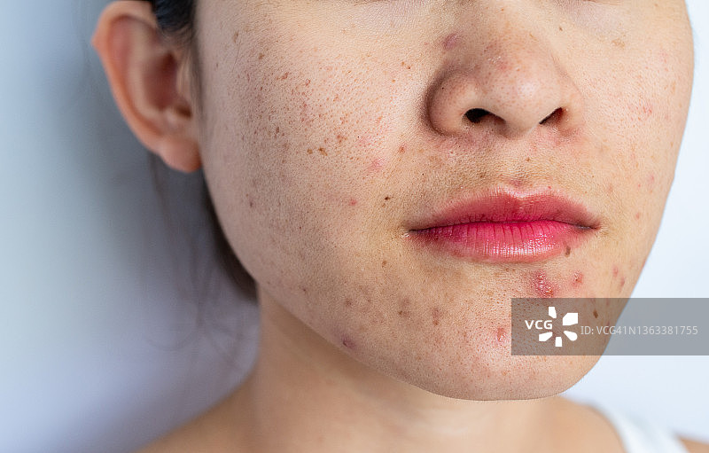 亚洲女性面部痤疮发炎特写图片素材