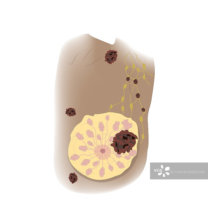 女性T4期乳腺癌插图图片素材