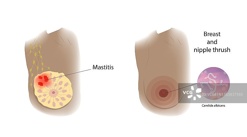 乳腺炎和鹅口疮对比图图片素材
