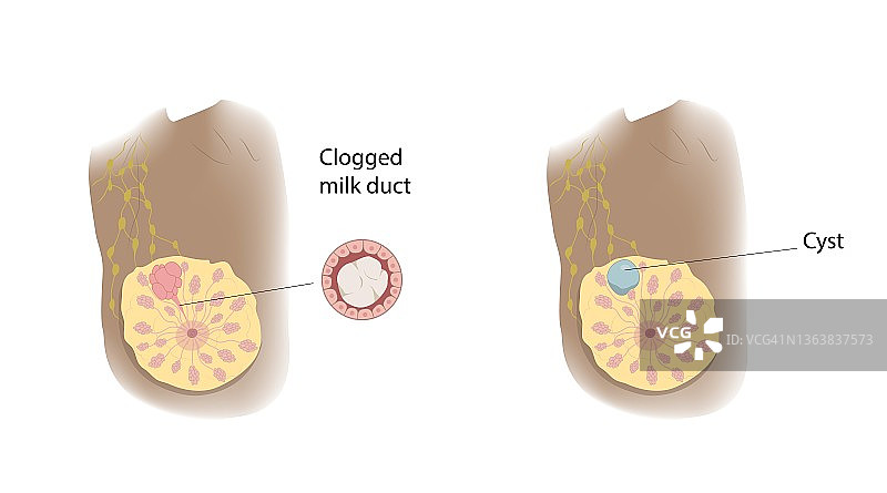 乳腺导管堵塞与囊肿对比插图图片素材