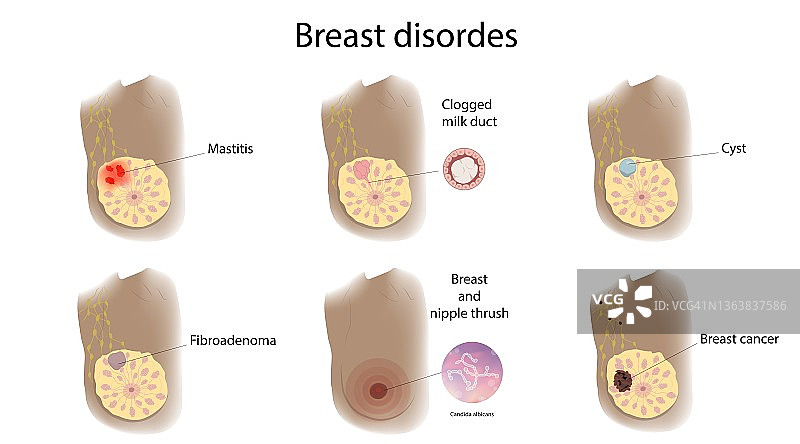 女性乳腺疾病插图图片素材