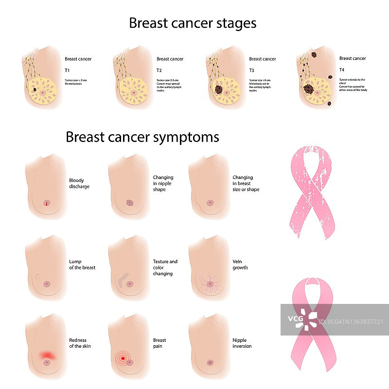 女性乳腺癌症状和阶段图示图片素材