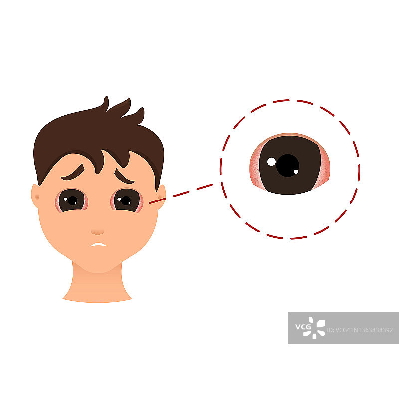 结膜炎概念图图片素材