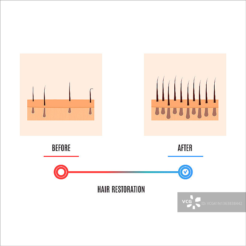 植发概念插图图片素材