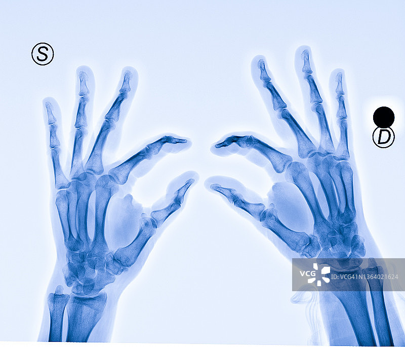 手部X光片图片素材