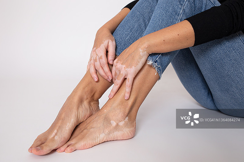 手和脚与白癜风图片素材