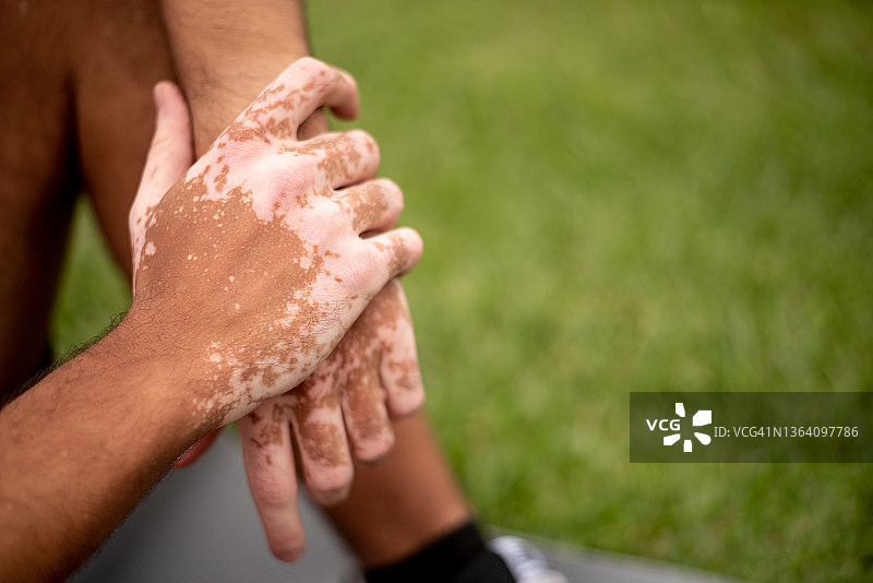 男人手部白癜风图片素材